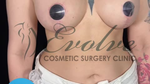 9 Months Post T-Lift Transformation | Breast Augmentation Before & After @evolvecosmeticclinic