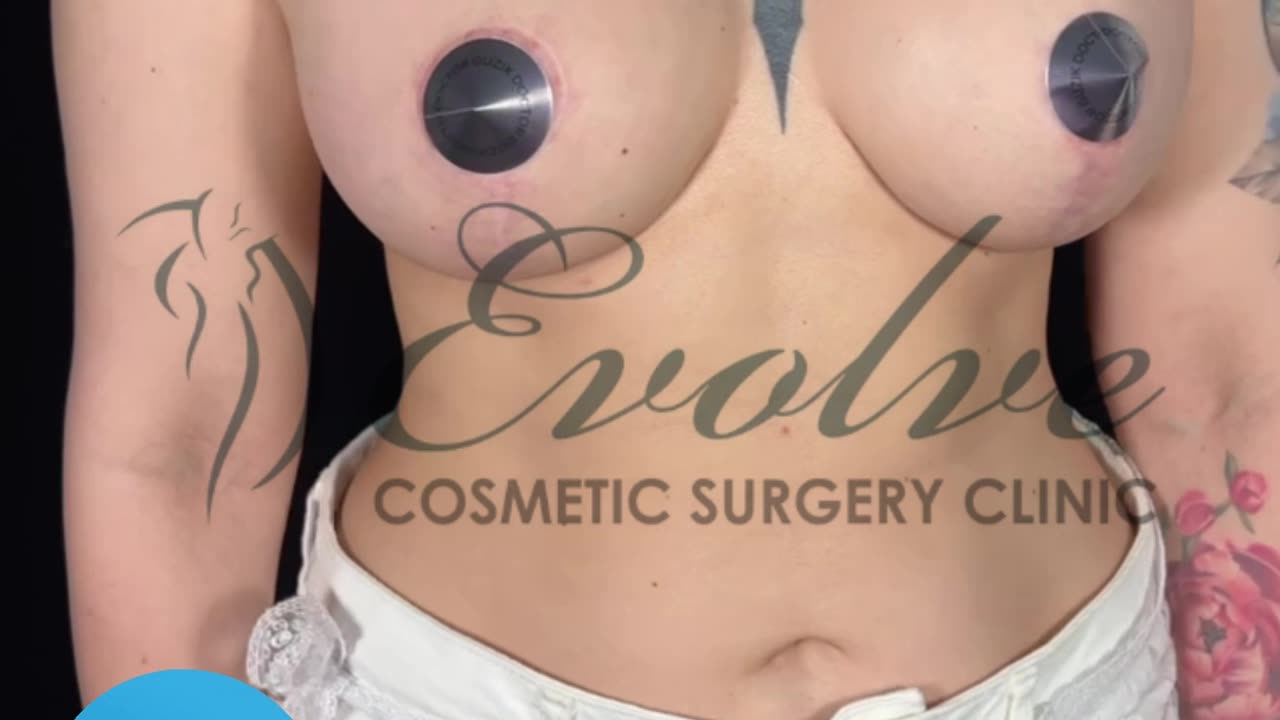 9 Months Post T-Lift Transformation | Breast Augmentation Before & After @evolvecosmeticclinic