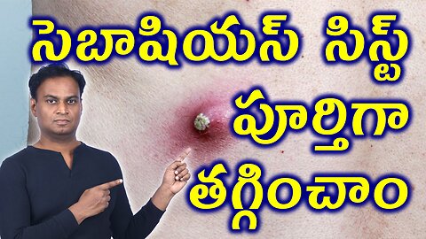 సెబాషియస్ సిస్ట్ కి చికిత్స | Permanant Cure For Sebaceous cyst Oil Gland Cyst Homeopathy Treatment