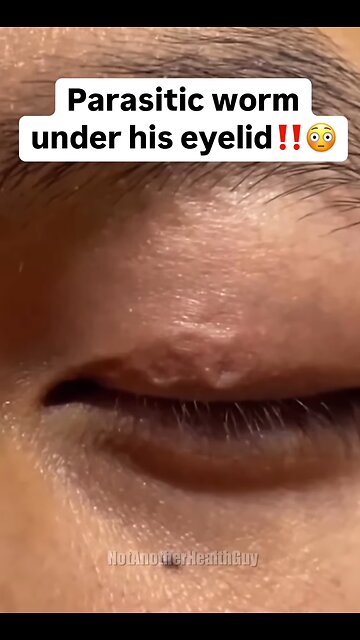 This is why it’s so important to regularly detox parasites 👇