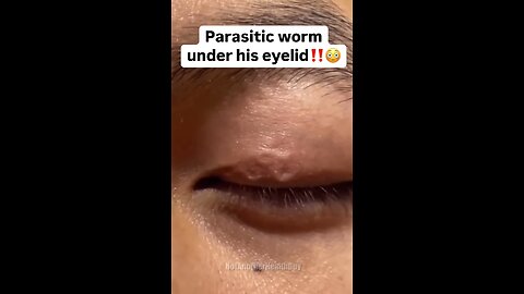 This is why it’s so important to regularly detox parasites 👇