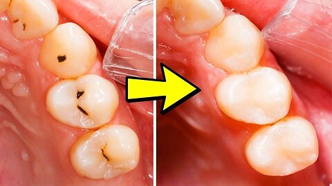 How To Get Rid of Teeth Cavities and Bleeding Gums