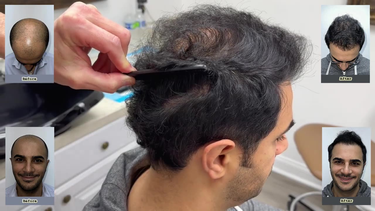 Dr. Brett Bolton Performs Another Excellent MaxHarvest™ Plus Procedure for Igor