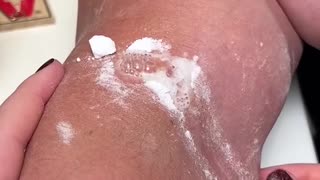 How to pop the whole pimple!😱