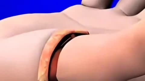 Thumb Implant Surgery – Step by Step Surgical Procedure for Thumb Joint Reconstr