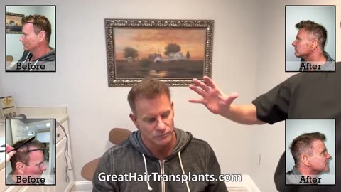 Kevin’s MaxHarvest™ Plus Hair Transplant by Dr. Brett Bolton