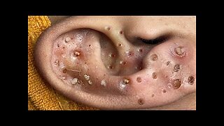 Blackheads Removal & Pimple Popper Cystic Acne Extraction 8