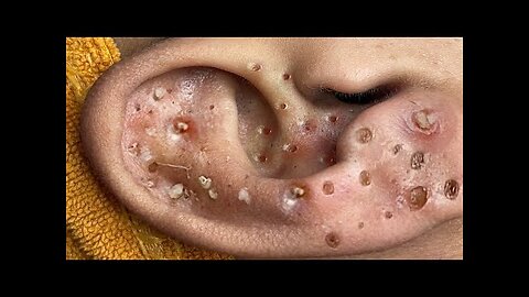 Blackheads Removal & Pimple Popper Cystic Acne Extraction 8