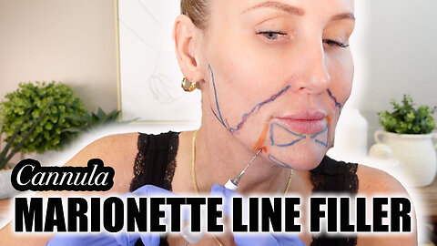 Marionette Line Filler with Cannula - Discount Code STACY10 at Acecosm.com