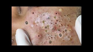 Deep relaxation with pimple Popper