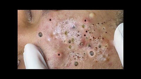 Deep relaxation with pimple Popper