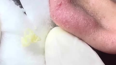 A Huge hidden pimple in his ear -