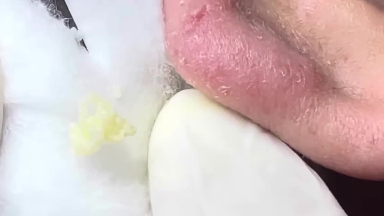 A Huge hidden pimple in his ear -