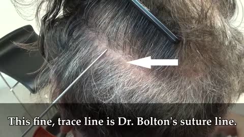 Amazing Corrective Hair Transplant Results by Dr. Brett Bolton