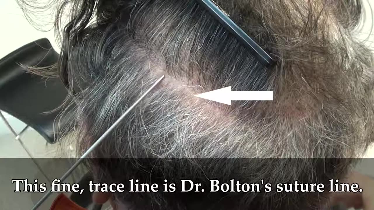 Amazing Corrective Hair Transplant Results by Dr. Brett Bolton