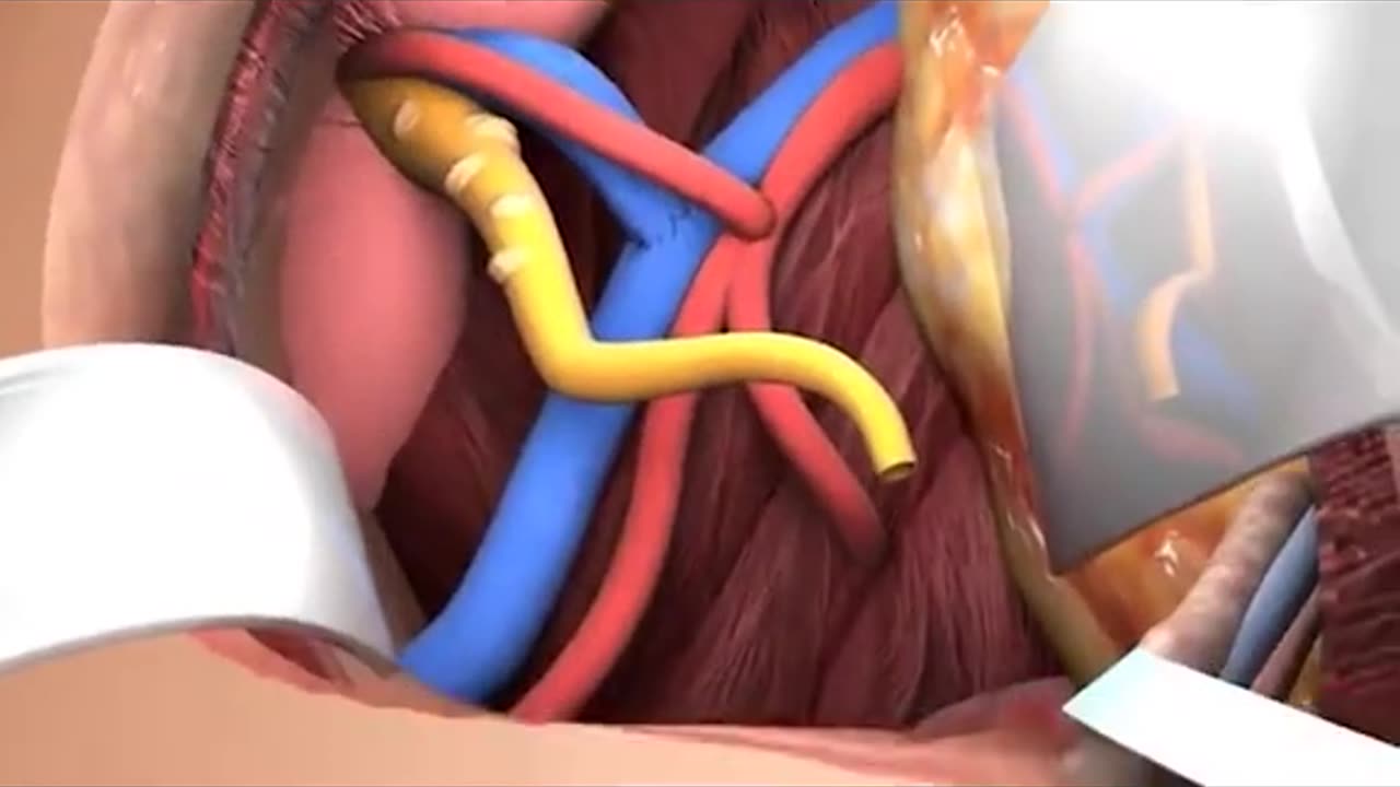 Kidney Transplant Surgery 3D Animation