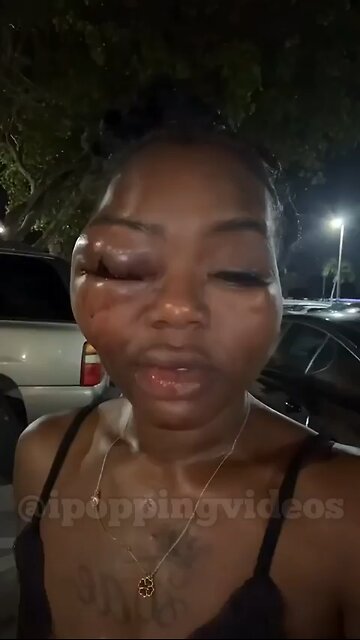 This woman got into a serious fight, leaving half of her face swollen and her eye swollen shut
