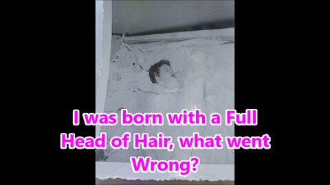 My Hair loss Chronicles | Photo Diary (Yikes !!) | Alopecia Awareness Month