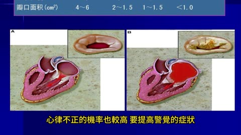 小感冒警惕 引爆心臟病