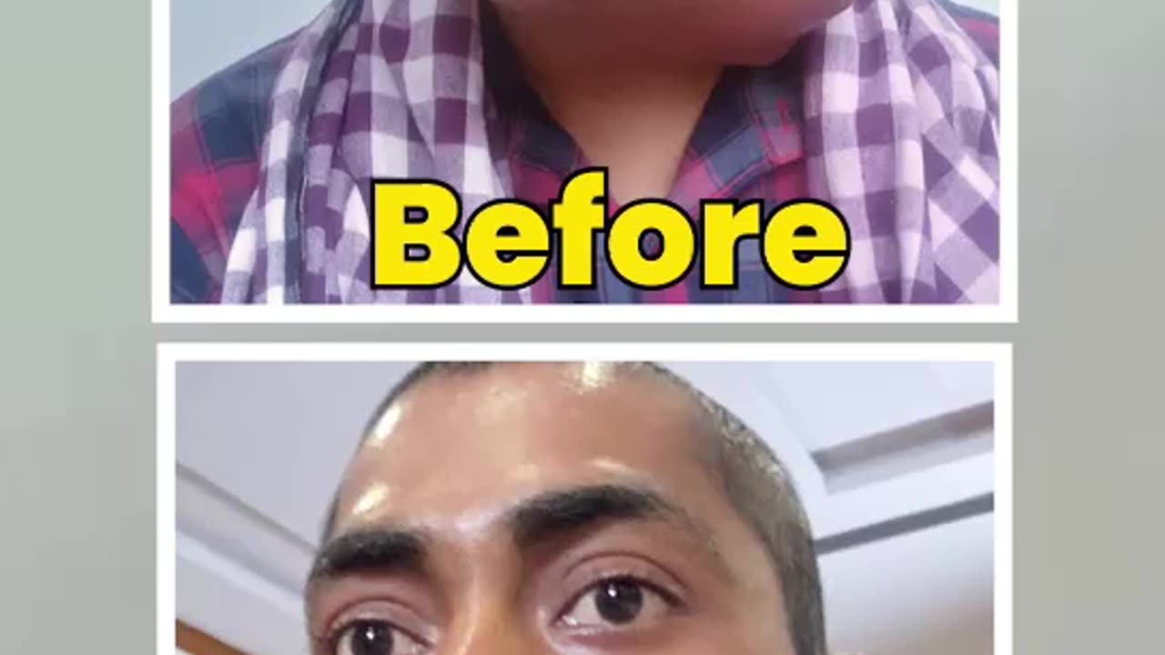 डॉक्टरों ने कहा ये लड़का नहीं बचेगा – HIIMS ने बचाई जान, अब जी रहे हैं सामान्य जिंदगी