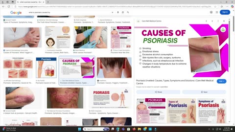 How to Prevent and STOP Psoriasis Flare Ups