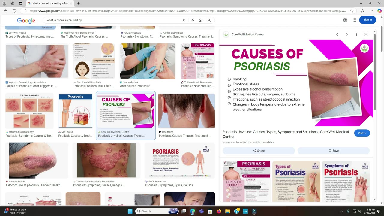 How to Prevent and STOP Psoriasis Flare Ups