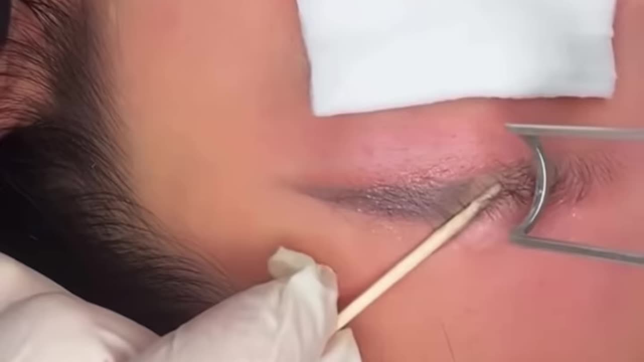 laser tattoo removal