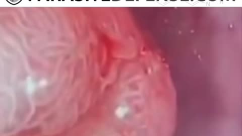 Parasites-in-cancer-sack-they-all-lied