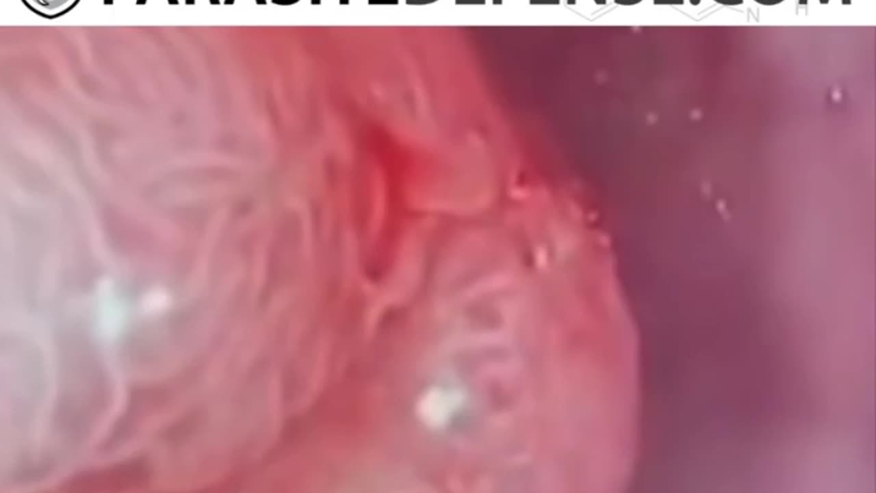 Parasites-in-cancer-sack-they-all-lied