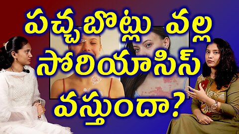 పచ్చబొట్లు వల్ల సోరియాసిస్ వస్తుందా? Does Tattoo Causes Psoriasis Best Treatment Cure Medicine