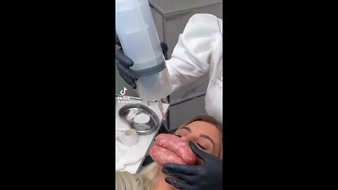 Woman with lip fillers goes totally wrong