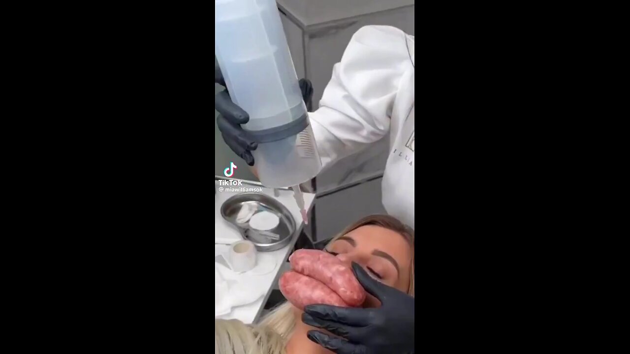 Woman with lip fillers goes totally wrong