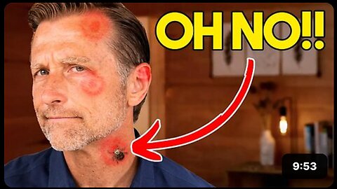 I Get 20 Tick Bites Every Week (Lyme Disease)