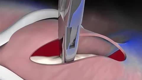 Vasectomy Birth Control Procedure (3D Animation)