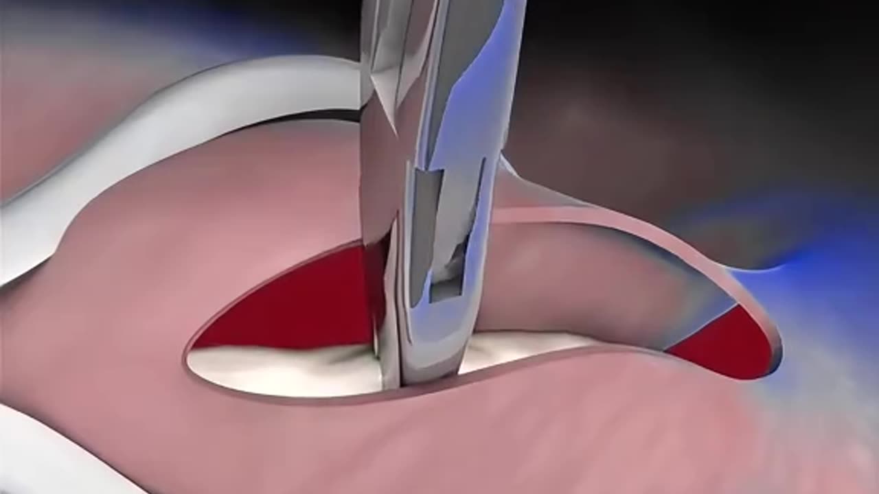 Vasectomy Birth Control Procedure (3D Animation)