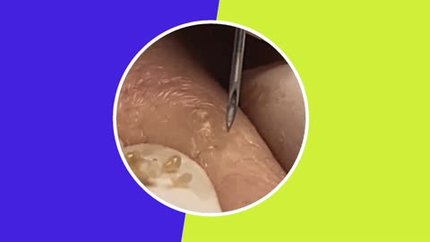 Skincare | Blackheads Removal (ASMR) #4 #tweezers #skincare #blackheads