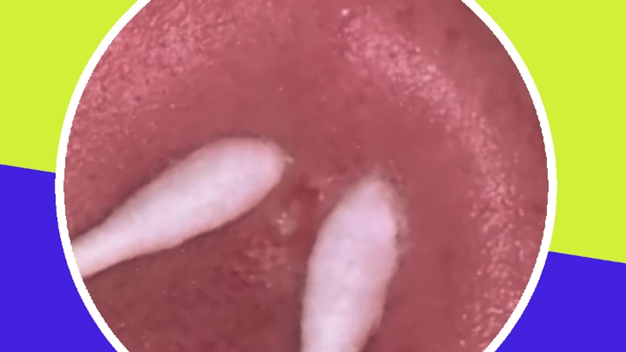 Pimple removal satisfying video (ASMR) #13 #shorts