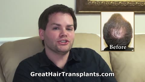 Dr. Brett Bolton: Hear This Patient’s Honest Hair Transplant Testimonial