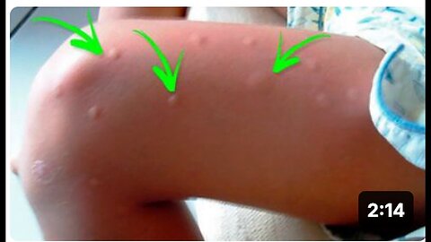 "Reasons Why Mosquitoes Prefer to Bite You Over Others"