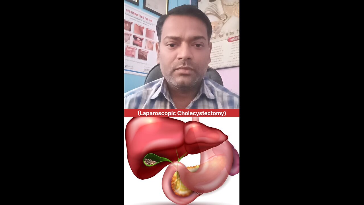 पित्ताशय की पथरी का कौन सा ऑपरेशन कराएं ।