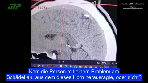 Neurologische Schäden durch die Covid-19-Impfung