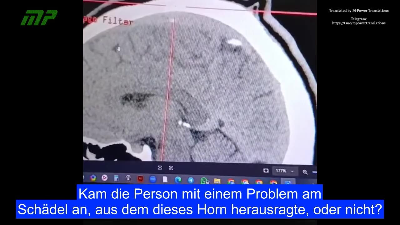 Neurologische Schäden durch die Covid-19-Impfung