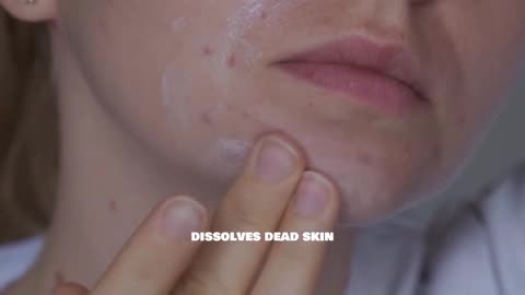 Top Skincare Ingredients to Fight Acne