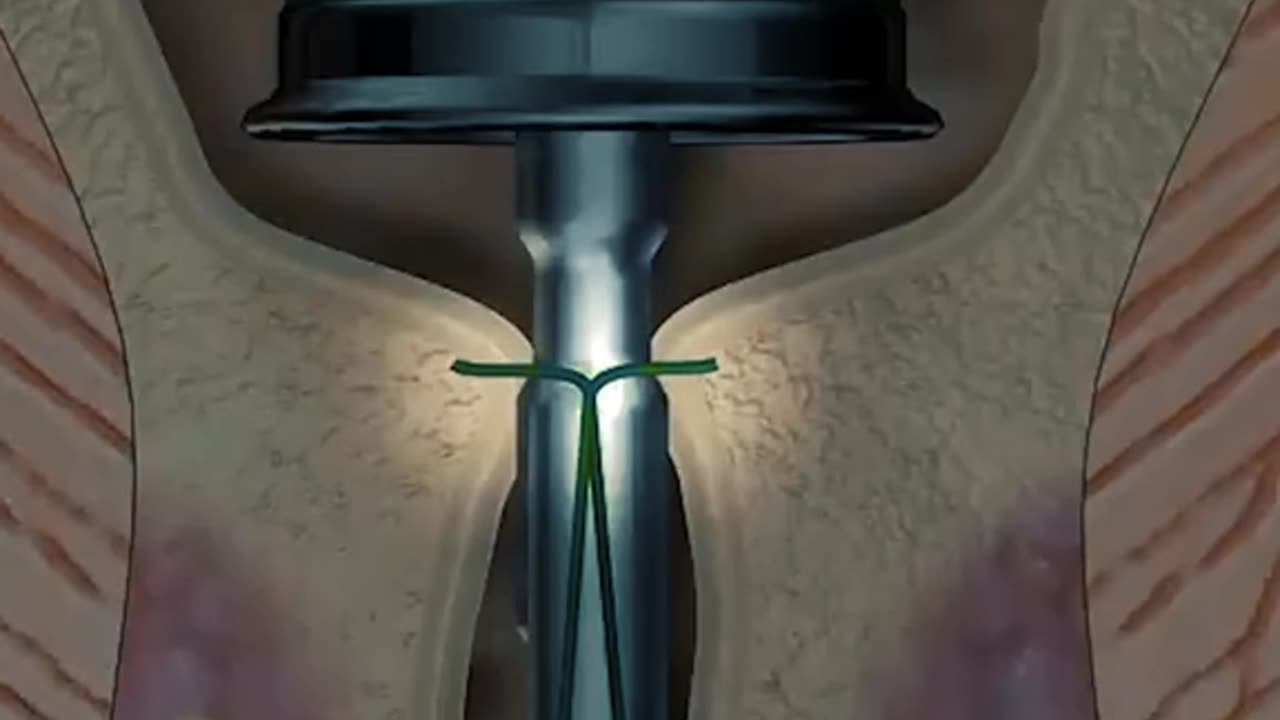 Piles Treatment 3D Animation (PPH Procedure)