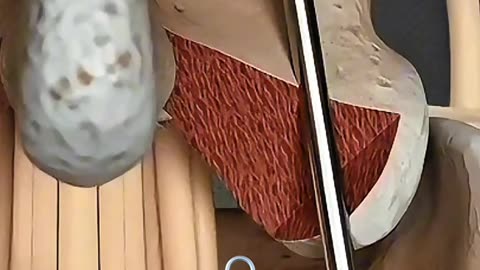 Crippling Back Pain This Surgery Fixes Ruptured Spinal Discs in Just Hours!...