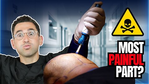 FAQ: Do You Really Need Anesthesia for a Hair Transplant? The Truth Will Surprise You!