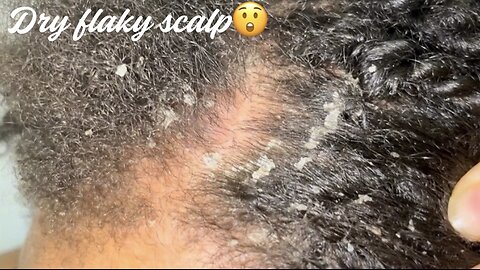 Dandruff removal from scalp #psoriasis #dandruff #asmr