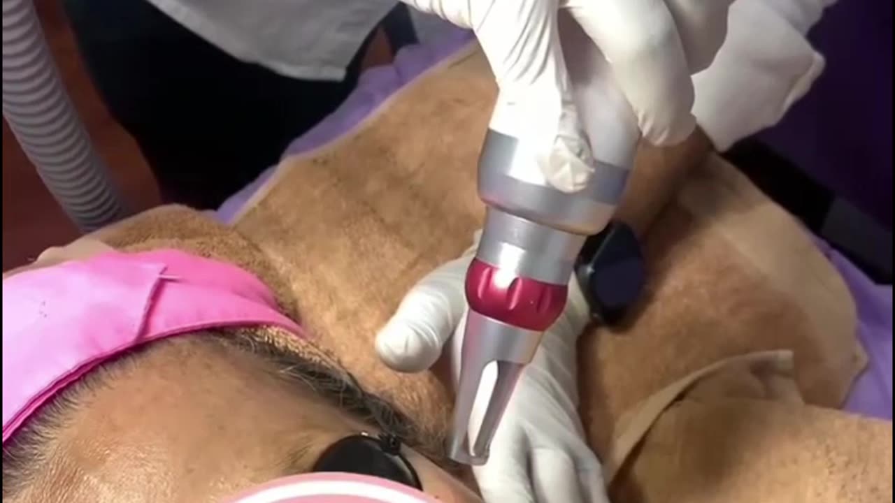 Hydrafacial vs. Chemical Peel: Which One Wins?