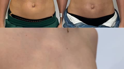 Anchor Breast Lift + Augmentation | Real 3-Month Scar Progress | Top Cosmetic Clinic in Mumbai