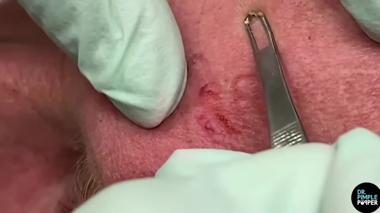 50 Minutes of Blackheads! Clusters of Blackheads with Dr. Pimple Popper